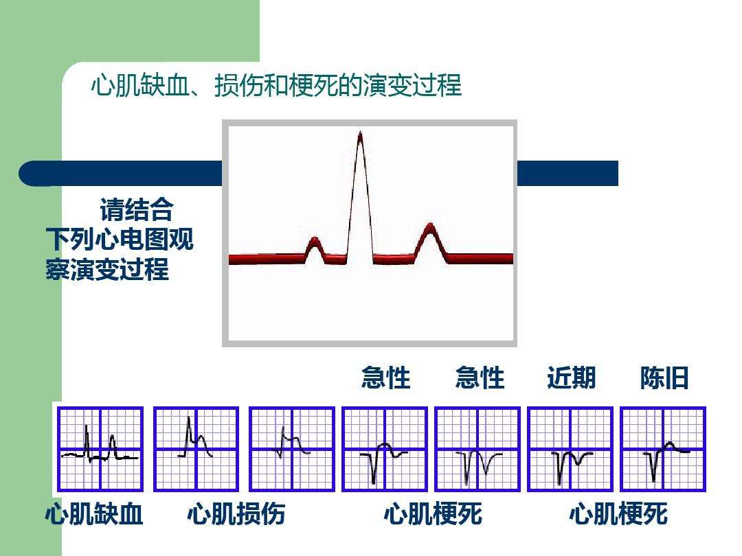 看心电图的七个步调的简单介绍