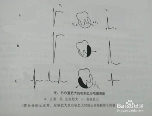 怎么看心电图(心电图怎么看图解)