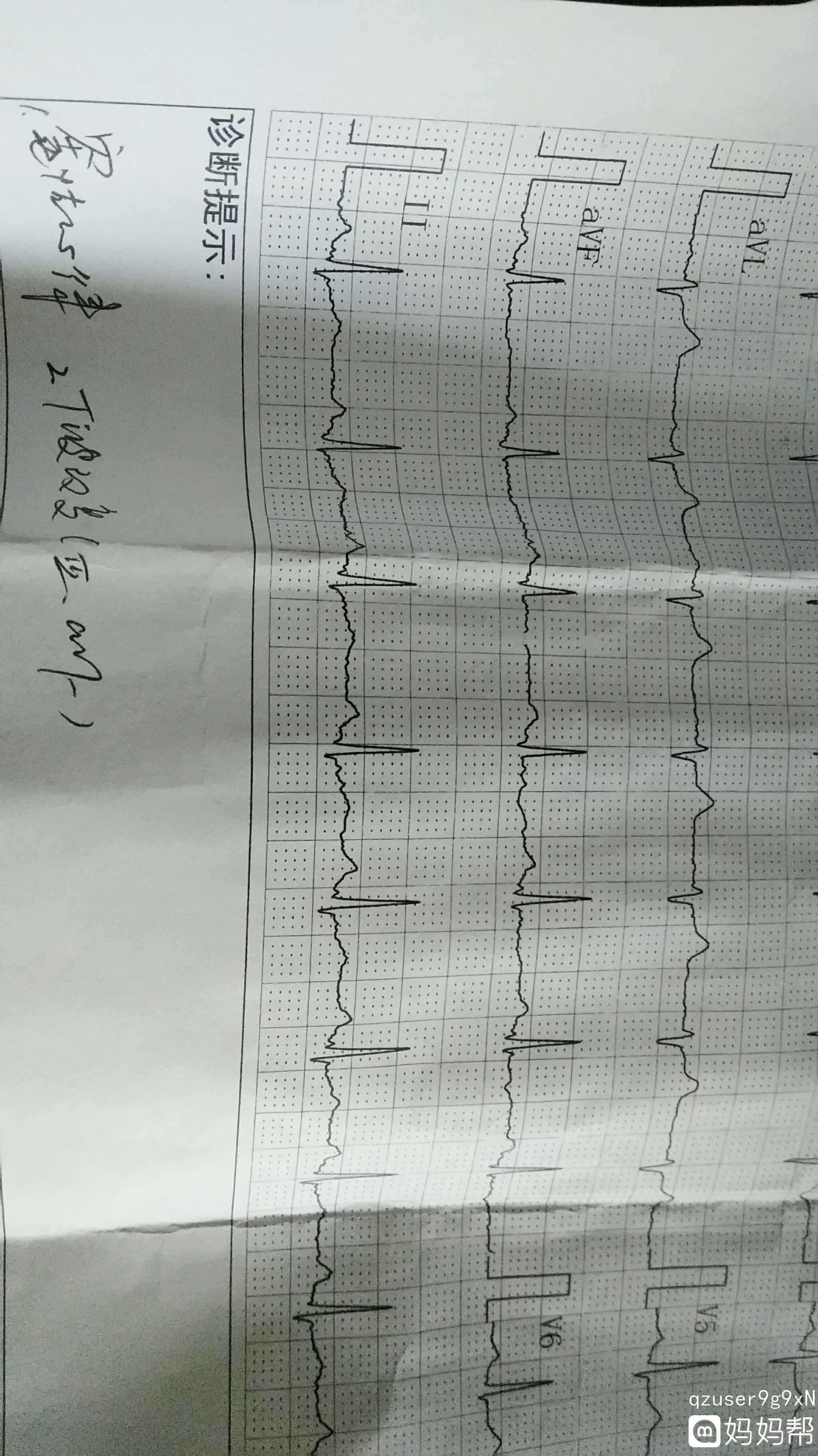 若何看心电图(若何看心电图视频教程)